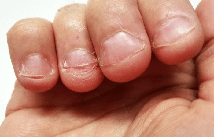 La solución definitiva para quien se muerde las uñas