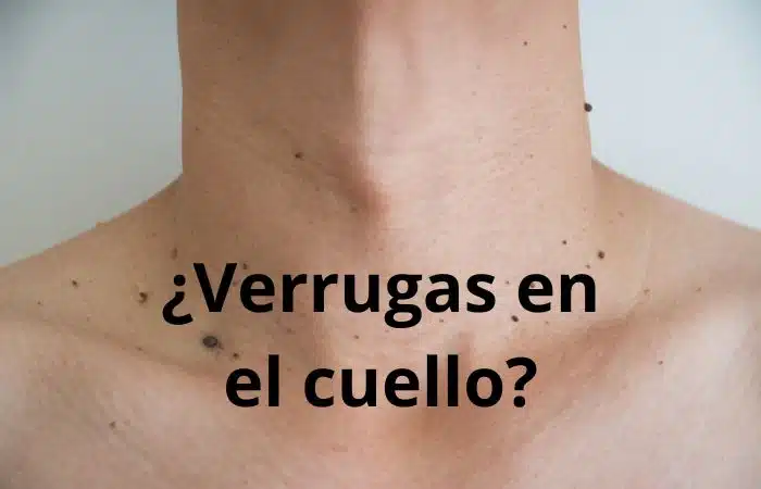 verrugas en el cuello